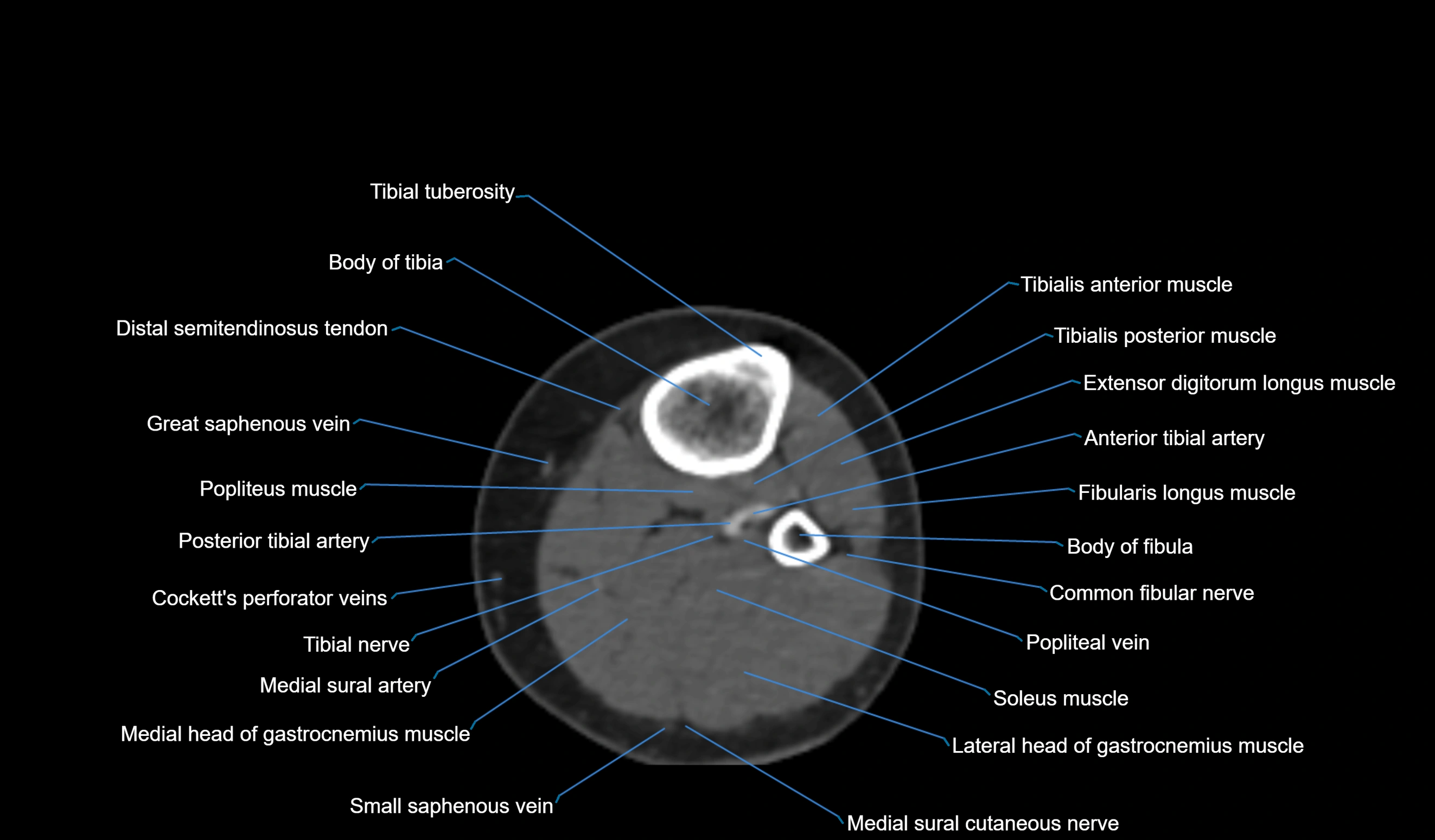 CT knee axial cross sectional anatomy labelled image-00054.webp